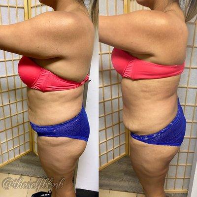 Body sculpting package