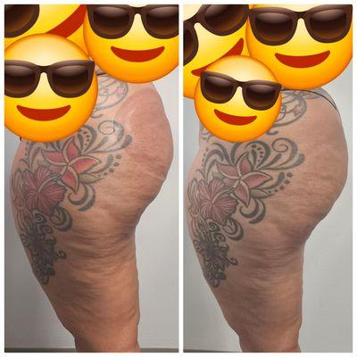 Butt enhancement pump therapy before and after.. Call us 470 377 3877 for more info. Mention this post and get 25% off