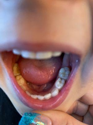 His teeth one cavity on the right in the back