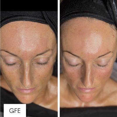 "The Works" Facial in action
- Dermaplanning
- Brightening Enzyme Treatment
- Double Masque with Steam
- Nanoneedling peptides