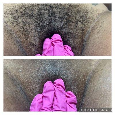 Brazilian wax before and after