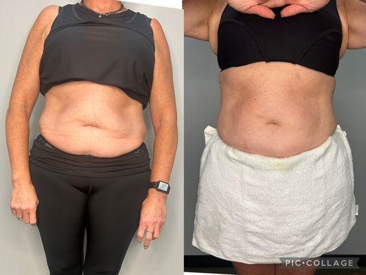 After just her second stomach slimming session, this client lost 2.5 inches! Real results with non-invasive body sculpting at Be Naked.