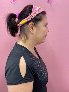 Before my treatment in the chin