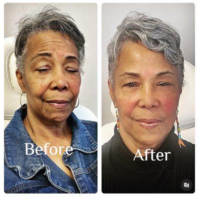 Non-surgical facelift using threads to reduce deep lines caused by the natural aging process and gravity.