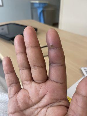 Tenosynovitis from a dog bite