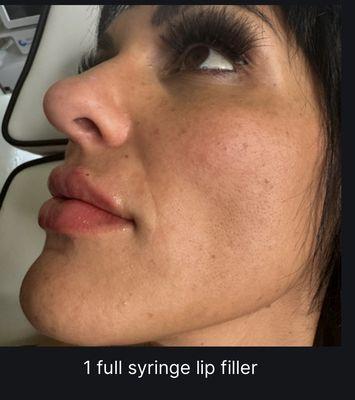 1 Full Syringe Lip Filler