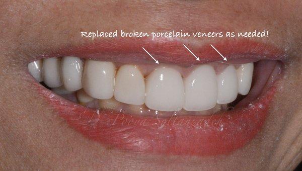 Patient had existing broken veneers. Rather than changing them all, only broken ones replaced.