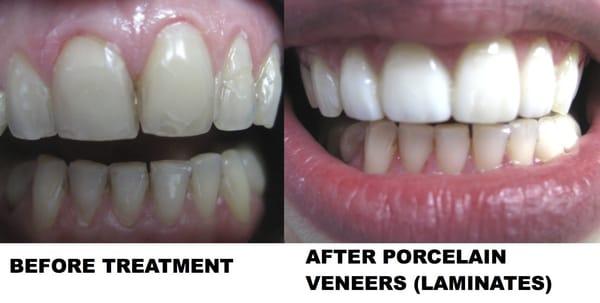 Porcelain Veneers