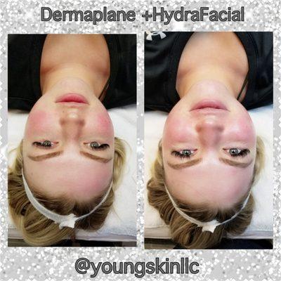 Before and after of the dermaplaning (removal of peach fuzz) and a customized infusion HydraFacial treatment!