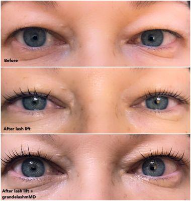 Before and after Lash Lift After 2 Mths Grandelash Serum 1/2017 - 3/2017