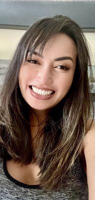 My photo after implant, I don't have a before photo cause I hate looking at my self with my missing teeth and I don't smile this big!