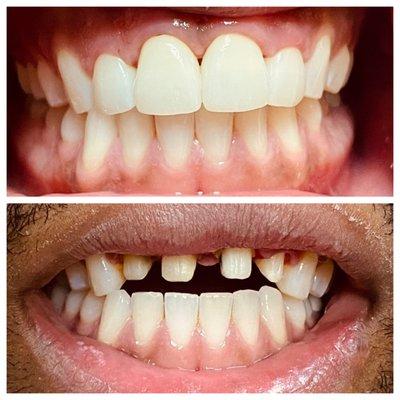 Front 4 Porcelain Crowns placed. Great Result!