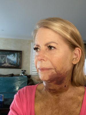 Horrific... and I had a weeding to go to in 2 weeks!