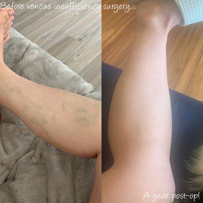 Before and after procedure photo!