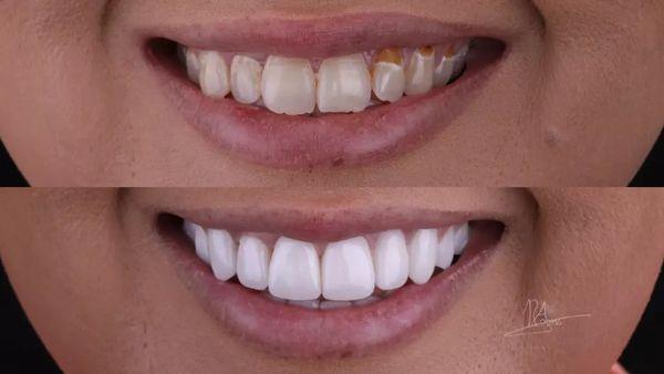 Full mouth rehabilitation - before and after transformation with custom veneers and Zirconia crowns.