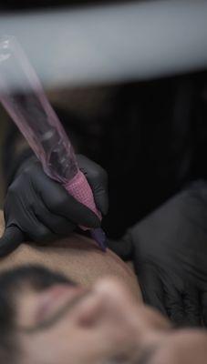 Advanced ISR treatment involves techniques to reduce scar appearance and improve skin texture