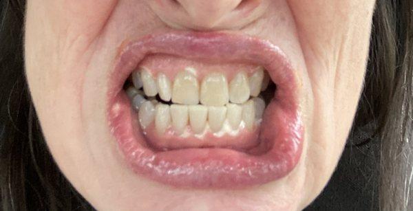 The left corner of my lip was burnt by the bleach too!