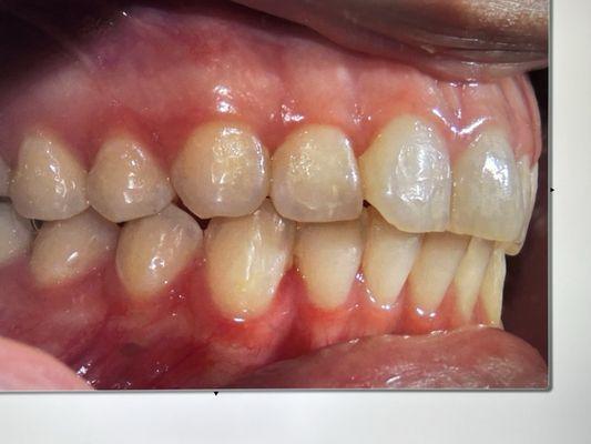 Had Invisalign's brackets taken off & they didn't remove it well AT ALL. Left my teeth with a film over it and rough glue.