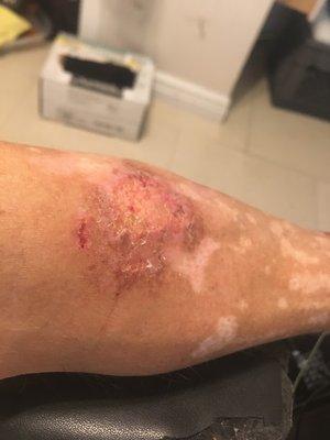 a small example of the resulting, PERMANENT SCARRING due *SOLEY* to SKOPIT'S INCOMPETENCE