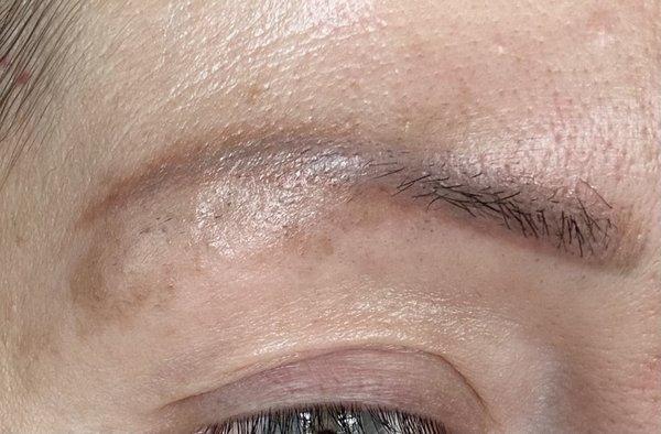 After laser treatment before Manuela Miami Brow Bar.