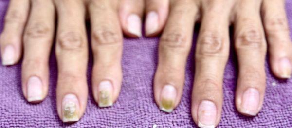 5 of my nails had black/green fungus/mold. 2 of them showed beginning signs. 3 had extensive damage