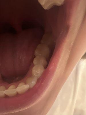 Amazing PAINLESS fillings done by Doctor Ash