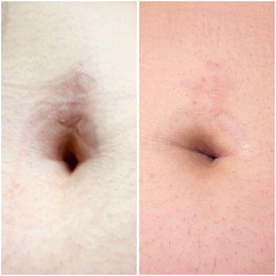 Inkless scar revision scar camouflage