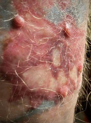 Ann Arbor Laser Tattoo Removal Specialists