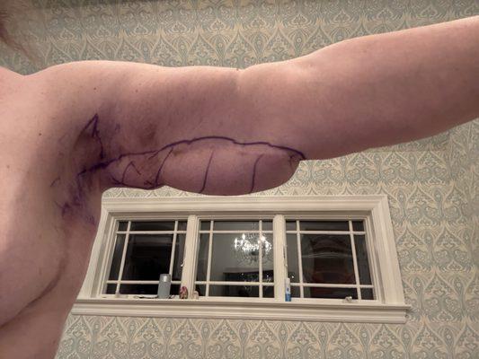 results after arm lift with dr. capella.