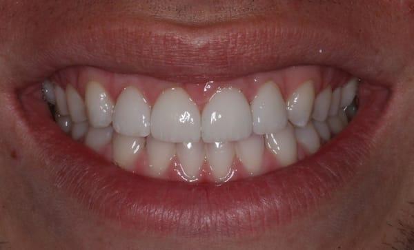 After: 4 Porcelain Veneers