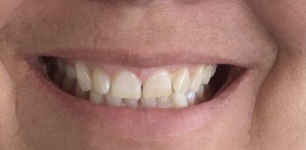 So much nicer now!!! Not too white, wasn't going for the fake look.