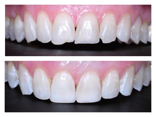 Conservative Cosmetic Composites allow us to modify the shape and edges of front teeth without needing Veneers.
