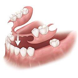 Partial Denture