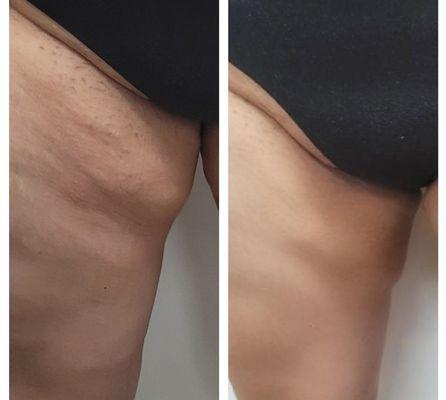 My right leg.. she photoshopped the after pic. I saw it in her phone when she took it and it didn't look like that.