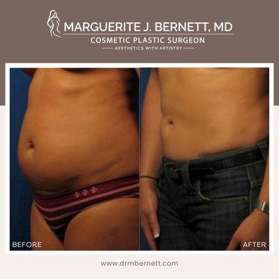 Liposuction by Dr. Marguerite Bernett