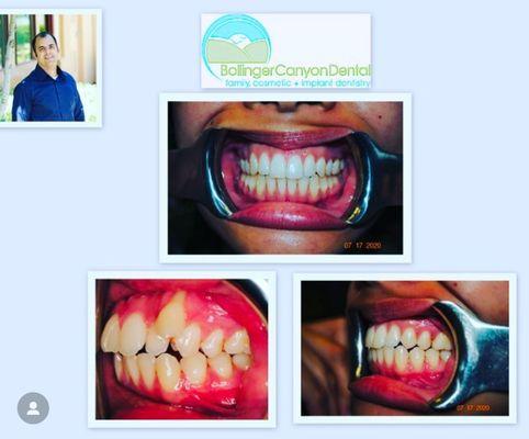 San Ramon Dentist - Bollinger Canyon Dental