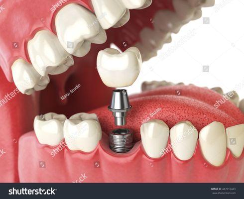 Dental implants all in one location ! EMERGENCY DENTAL & DENTURES