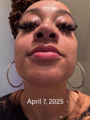 Restoration Electrolysis