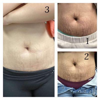 Nue stretch mark treatment