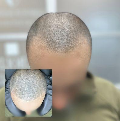 Scalp Micropigmentation