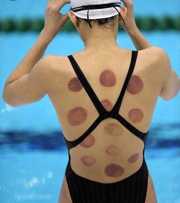Muscle cupping marks.