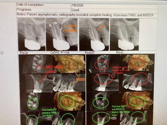 Maxillary Sinusitis from Dental Origin, MSDO, cured by Endodontic treatment!