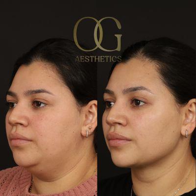 32 yo F 3 months after submental liposuction and RF Microneedling