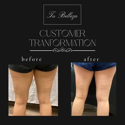 Cellulite Reduction