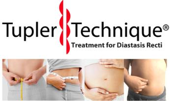 photo of Diastasis Rehab -.