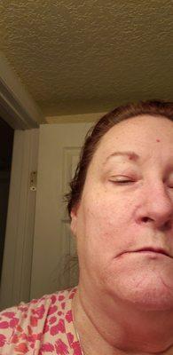 Blisters or sores from him pinching my lips