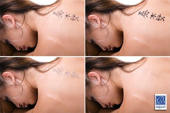 Rejuvi Tattoo Removal The most recognized method of Non-Laser COMPLETE removal of tattoo ink colors.