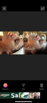 Before & After of a client after one treatment of natural collagen induction therapy.
