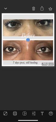 Another great result happening with a Vitamin Glow treatment for under eye circles!