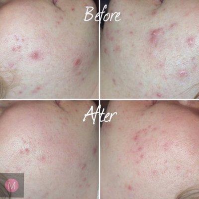 Before & after only 1 medical grade peel by Lauren Bridges